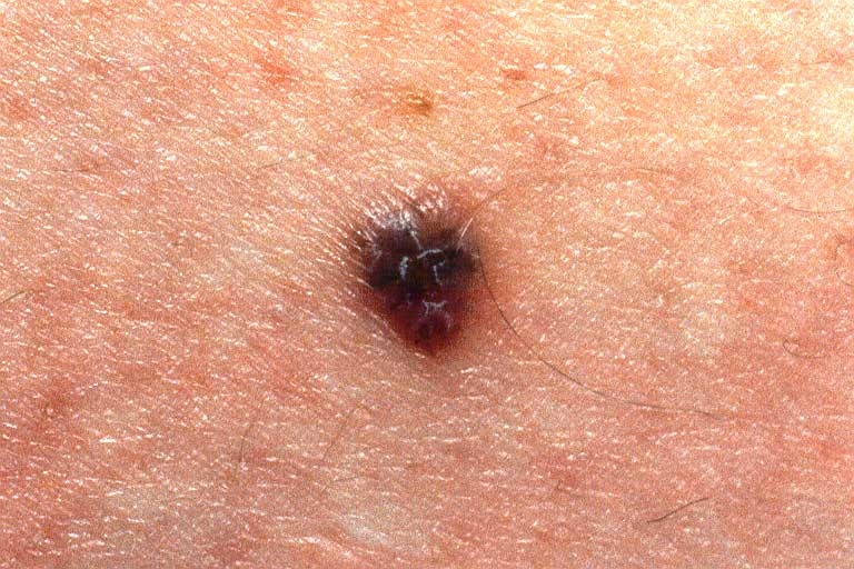 imagine cu melanomul malign